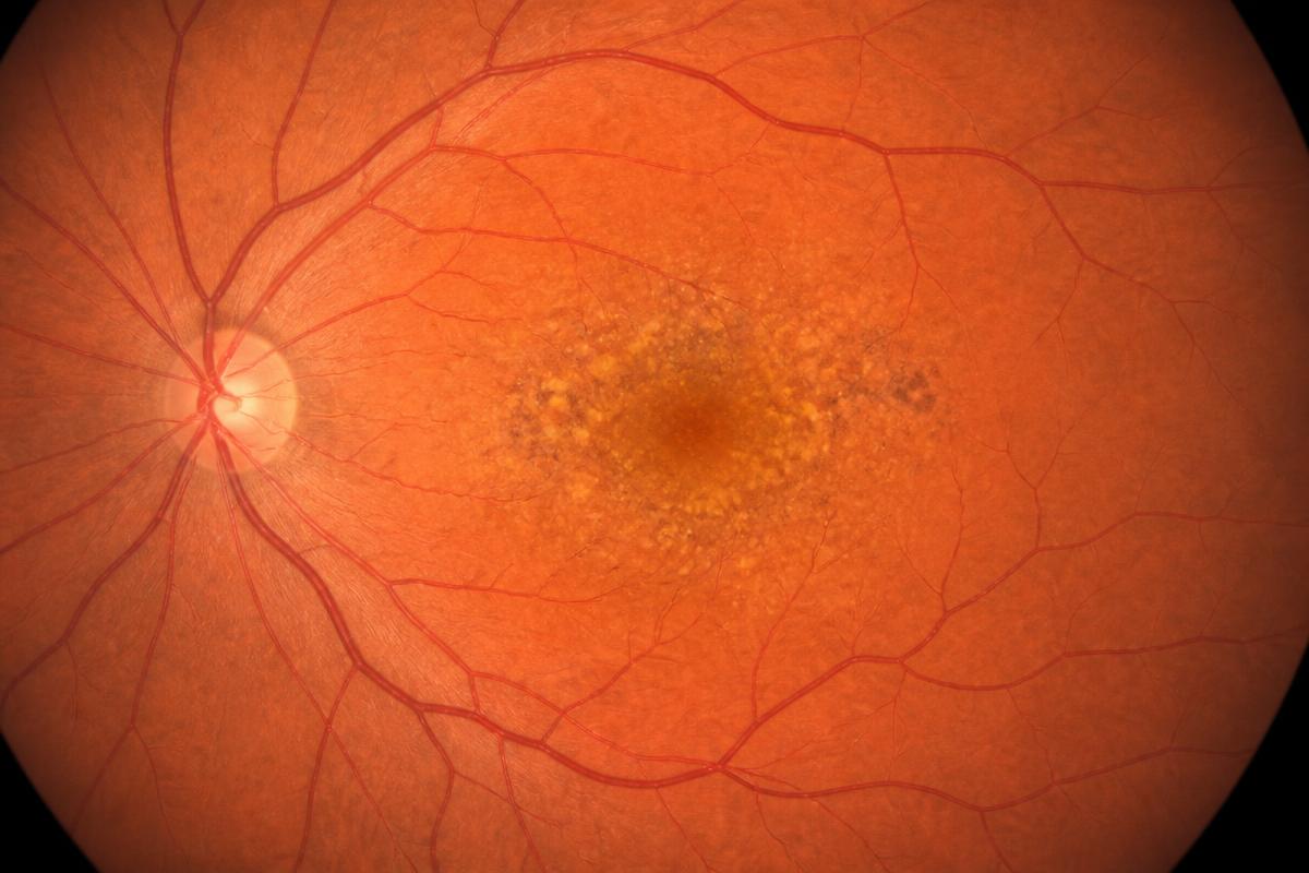 Fundus illustration showing drusen and pigment changes at the macula in age-related macular degeneration