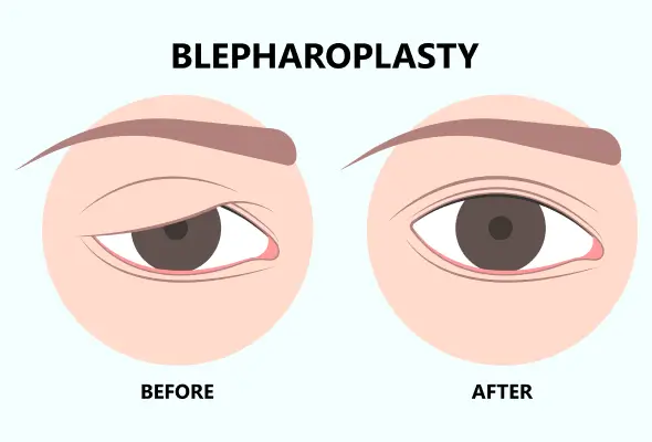 Illustration comparing an upper eyelid before and after blepharoplasty