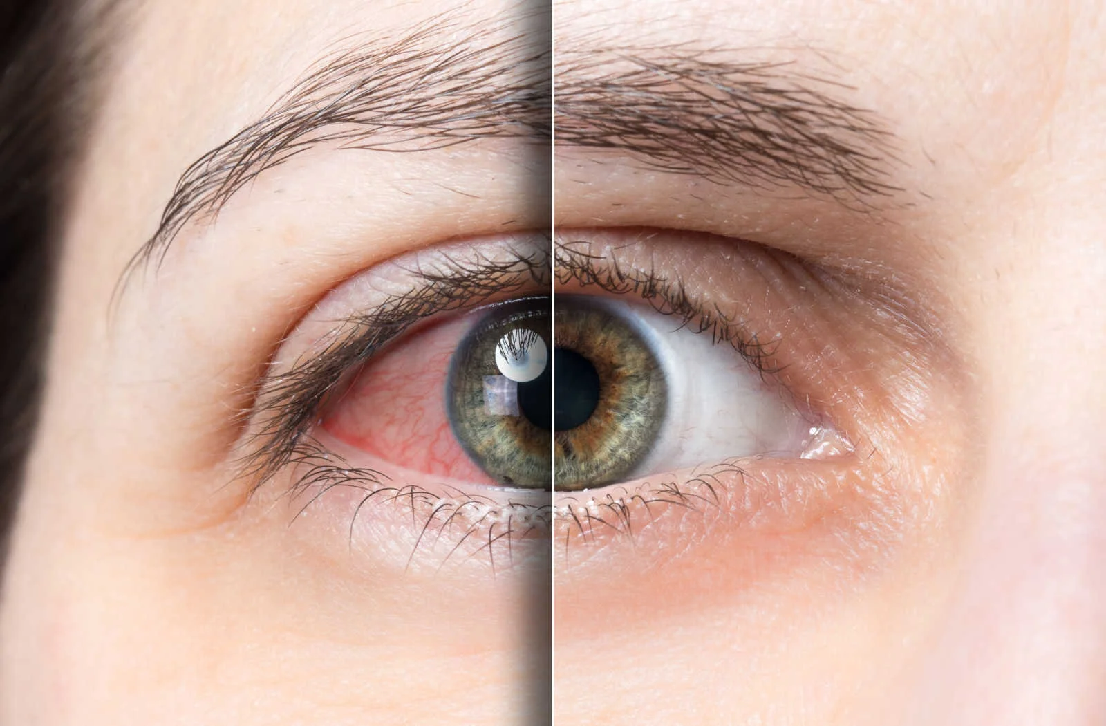 Close-up comparison of an irritated red eye and a comfortable healthy-looking eye