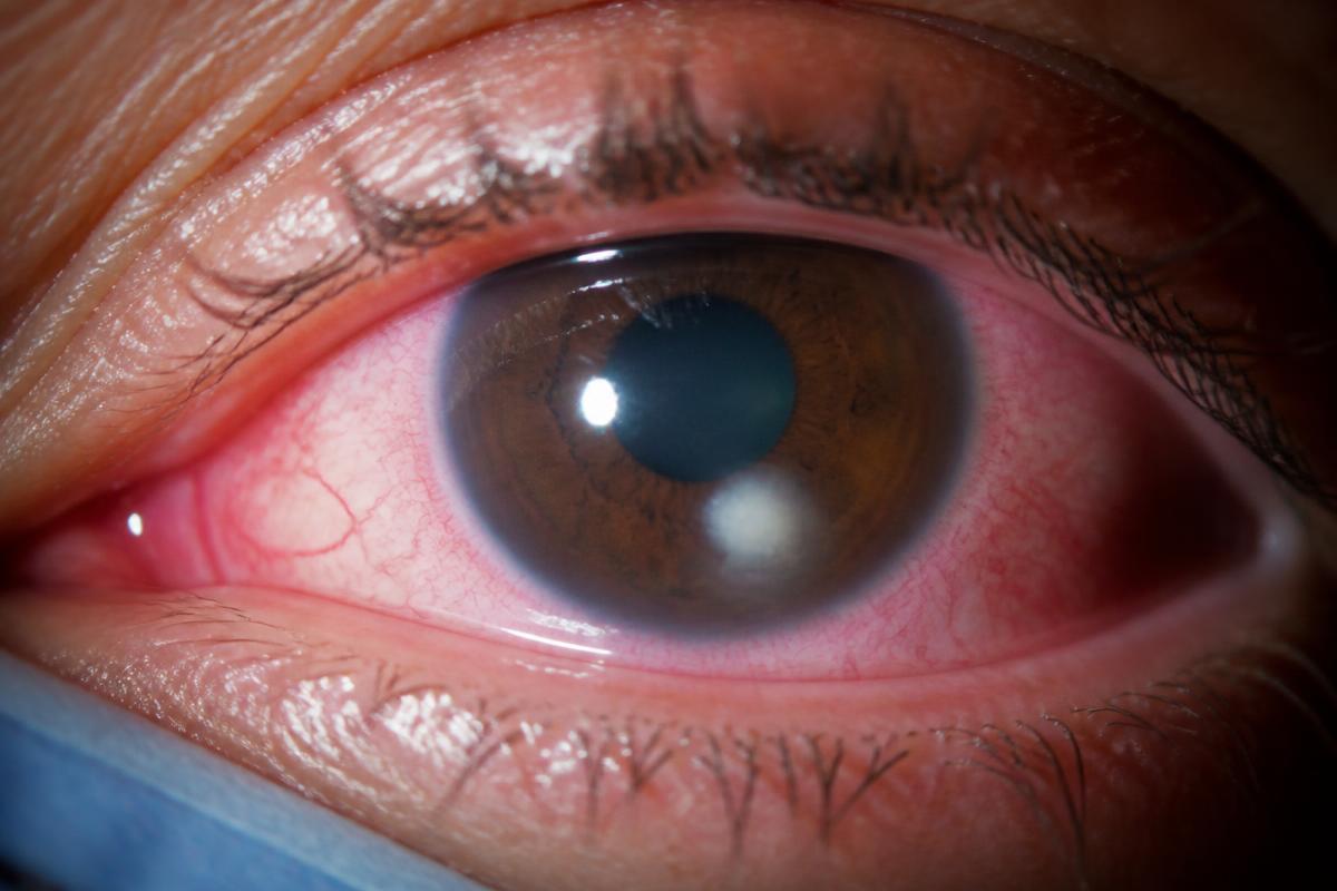 Close clinical view of an inflamed eye with a focal corneal ulcer