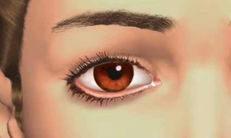 Close-up illustration of an eyelid turned away from its normal position