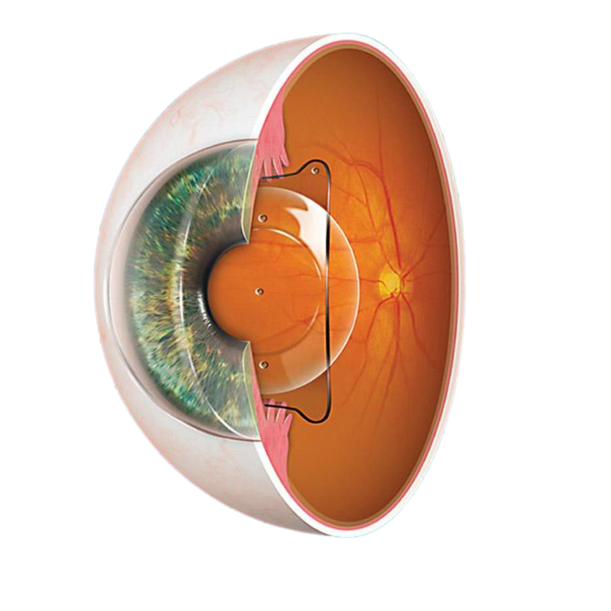 Cross-section of an eye showing an Implantable Collamer Lens positioned behind the iris and in front of the natural lens