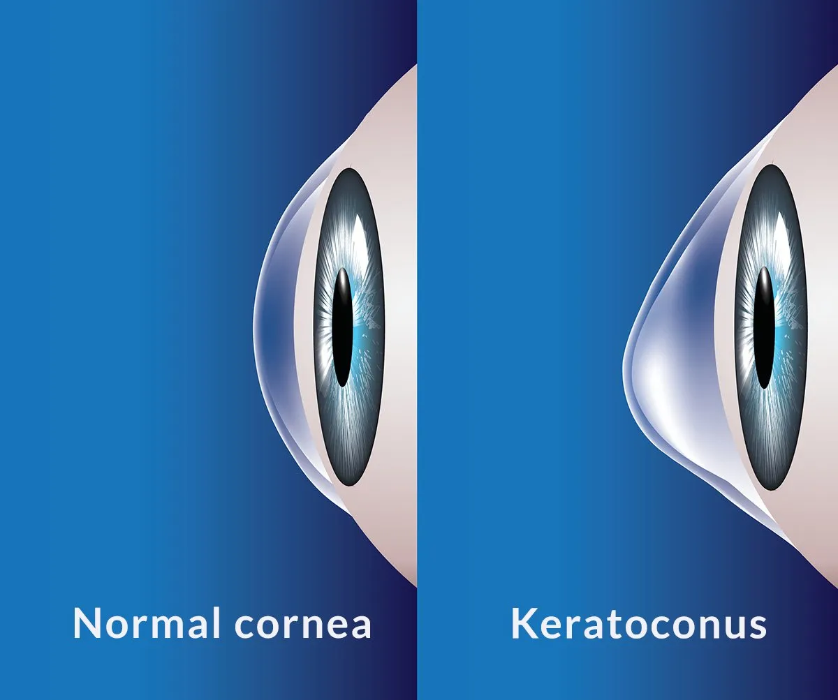 Side-by-side comparison of a normal cornea and a cone-shaped keratoconus cornea