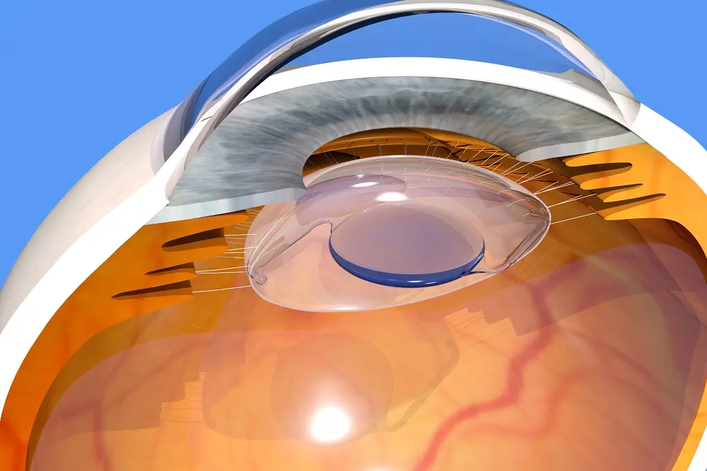 Cutaway illustration of an intraocular lens positioned inside the eye