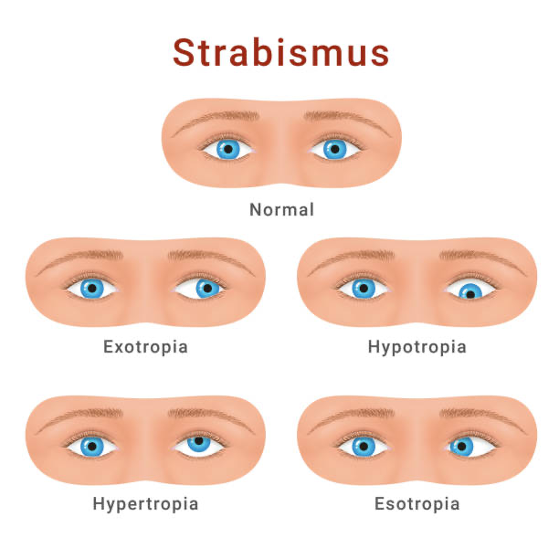 Diagram showing normal alignment, exotropia, hypotropia, hypertropia and esotropia